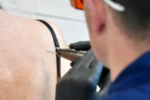 Athena Laser pilosité indésirable