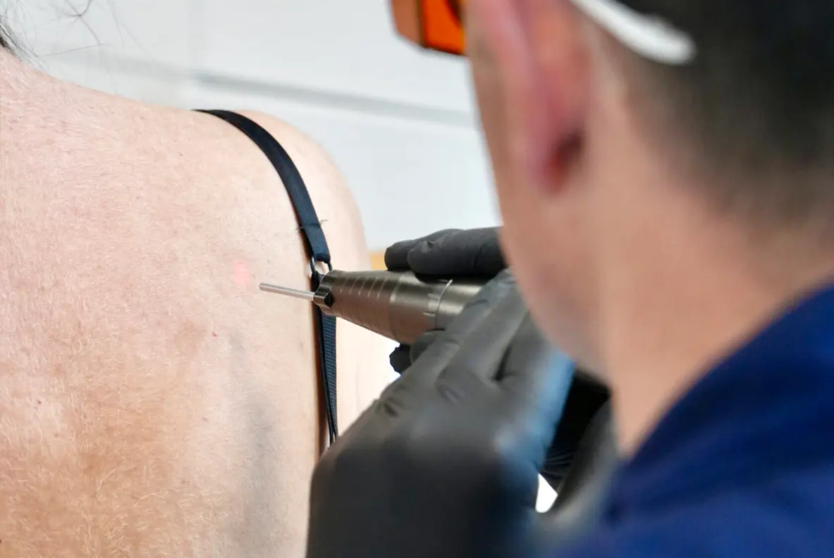 Athena Laser pilosité indésirable