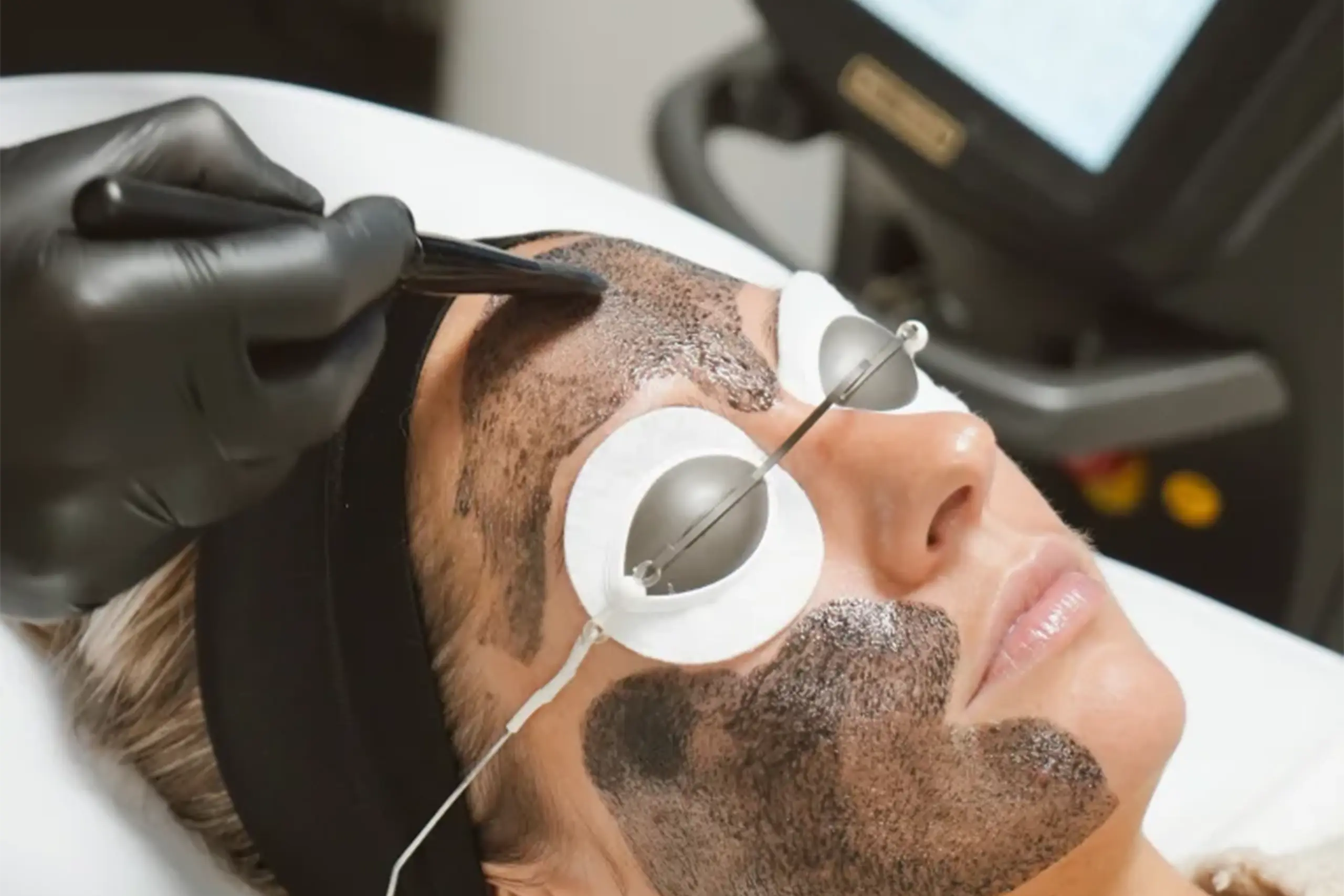 Athena Laser hollywood peel