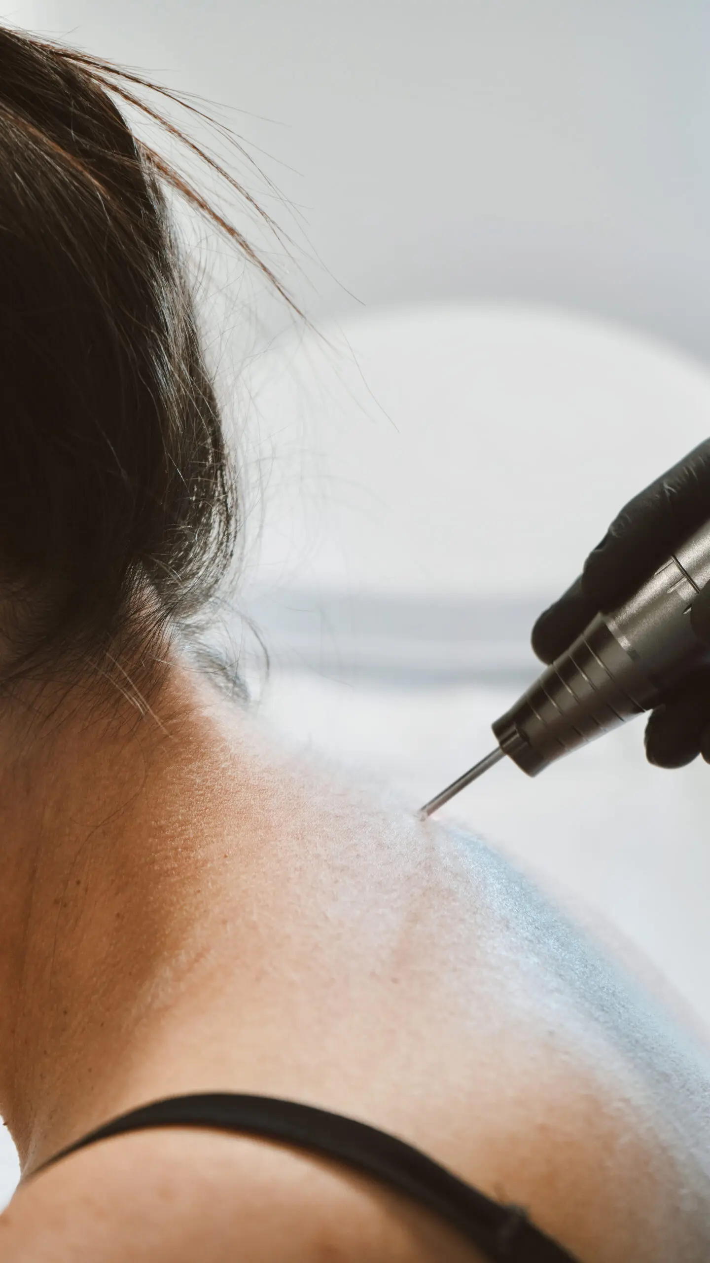 Athena Laser pilosité indésirable