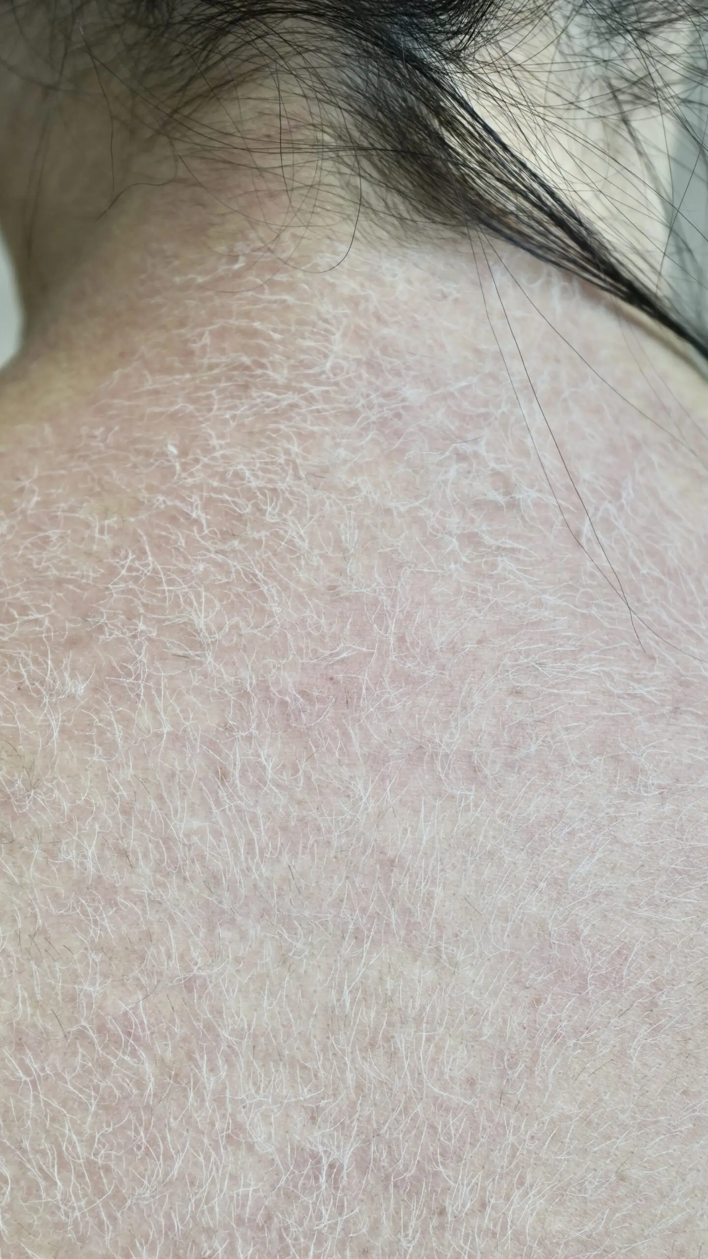 Athena Laser pilosité indésirable