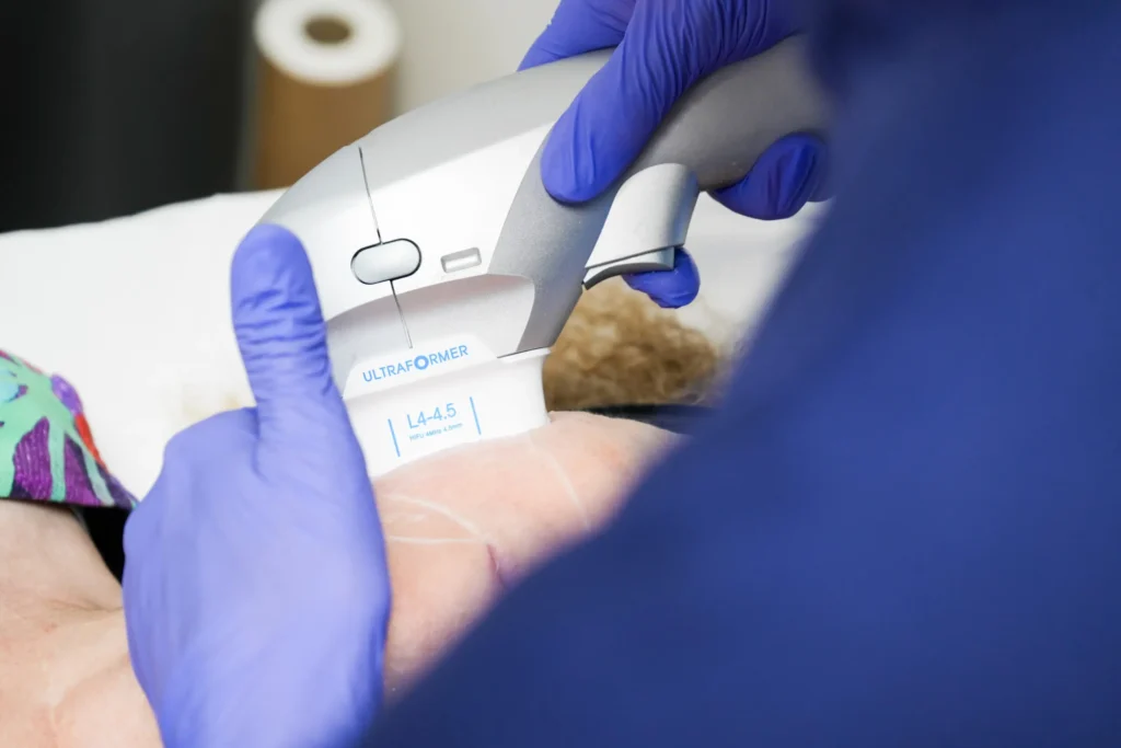 Athena laser HIFU