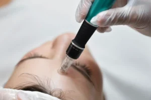 Athena Laser microneedling