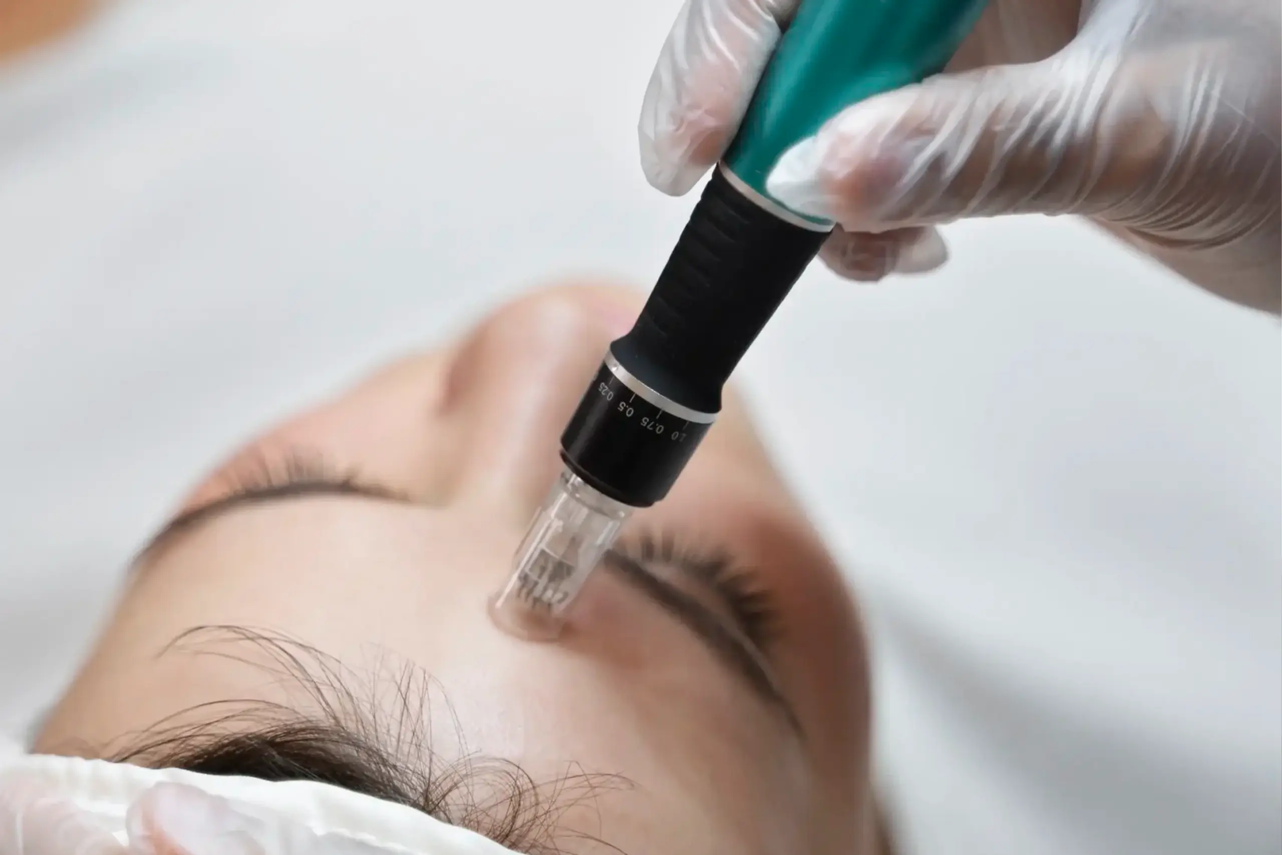 Athena Laser microneedling