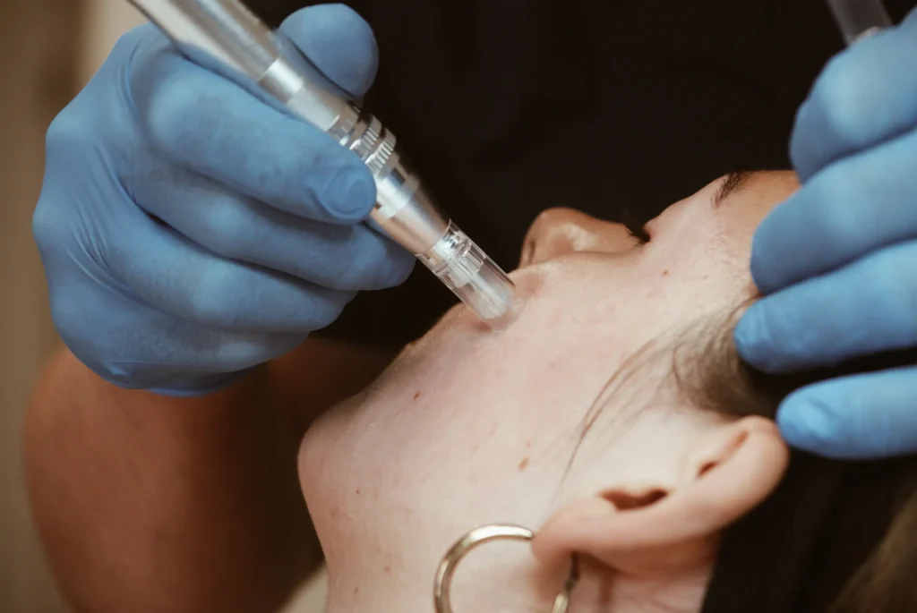 Athena laser microneedling