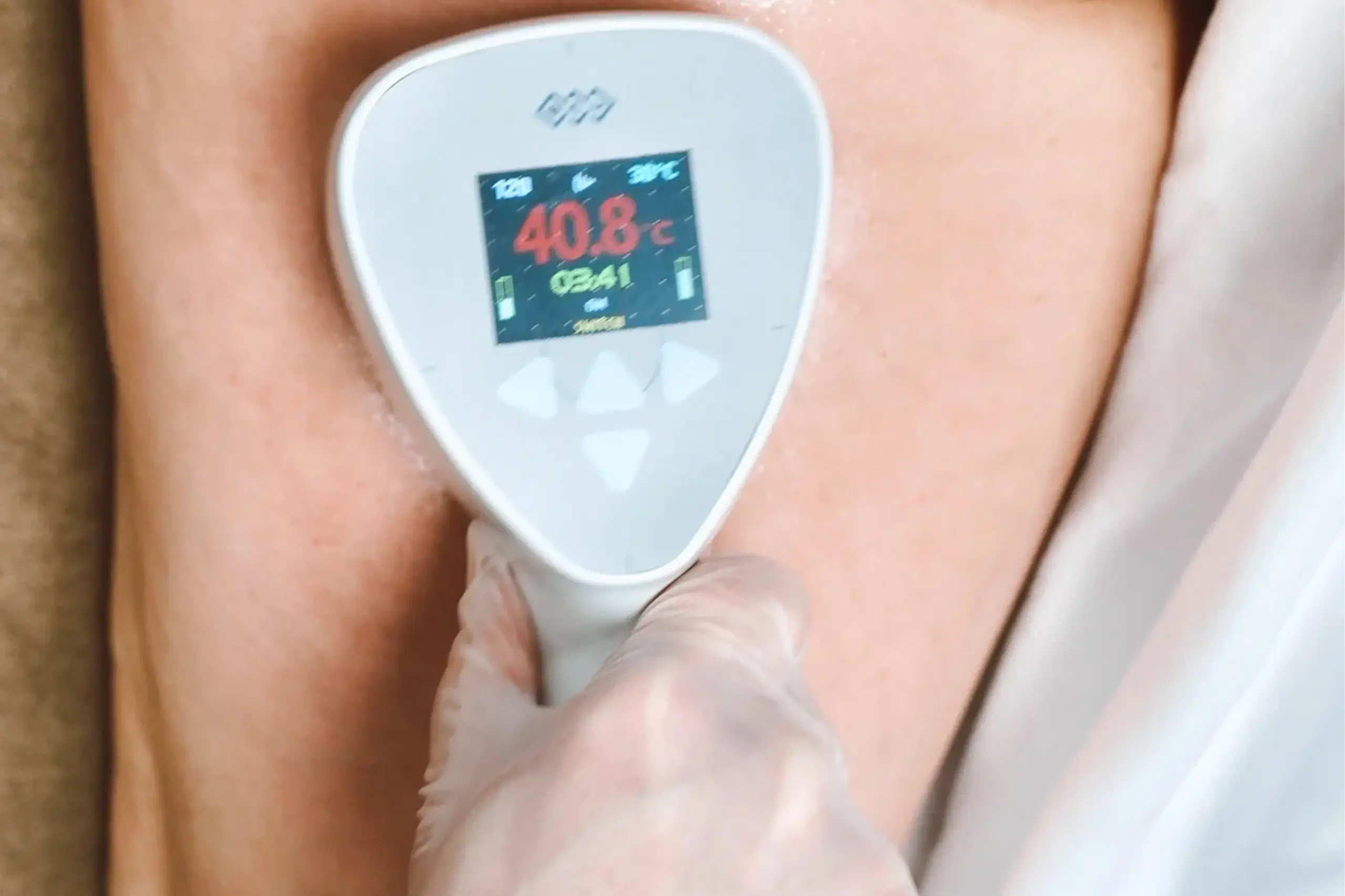 Athena Laser radiofréquence