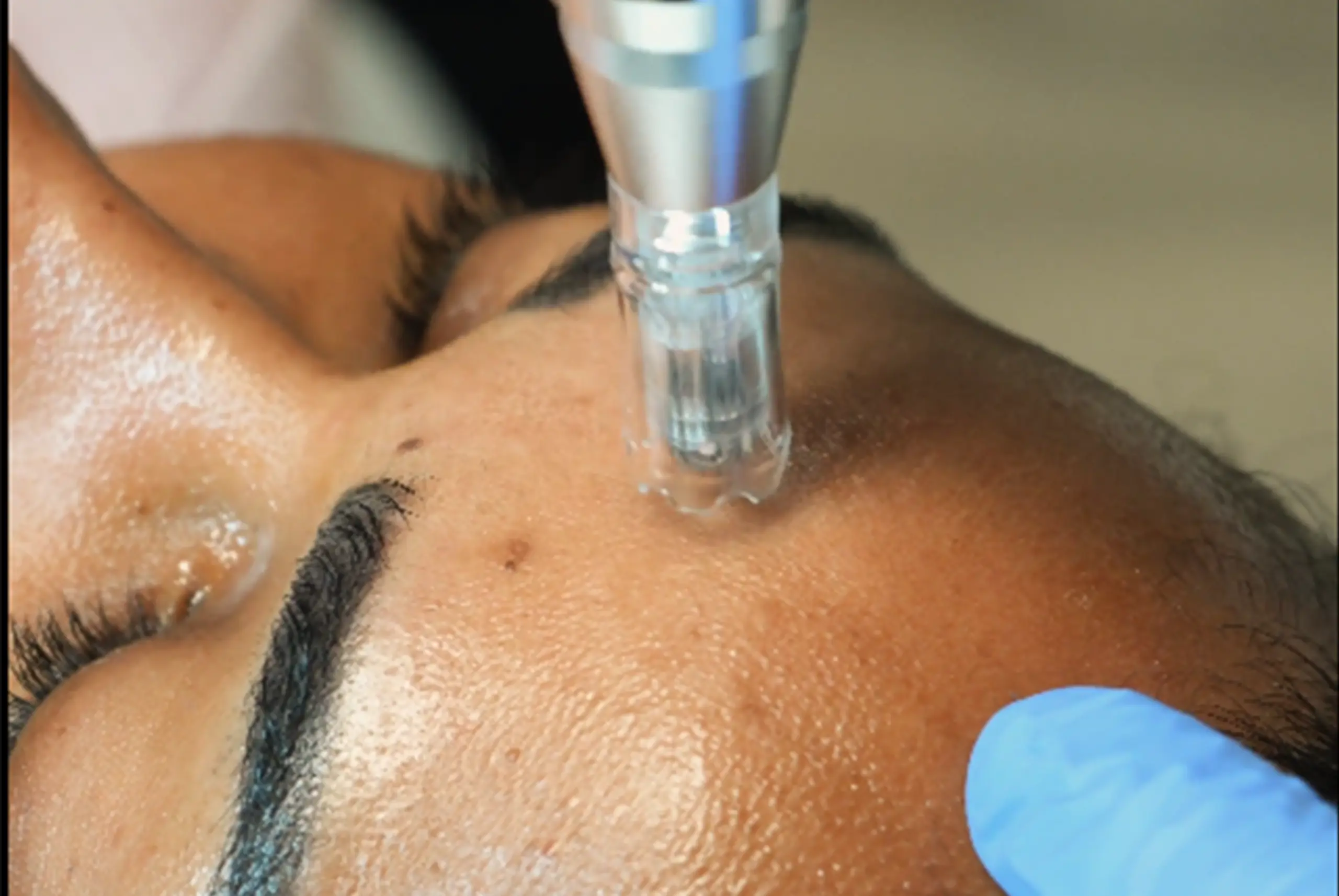 Athena Laser microneedling