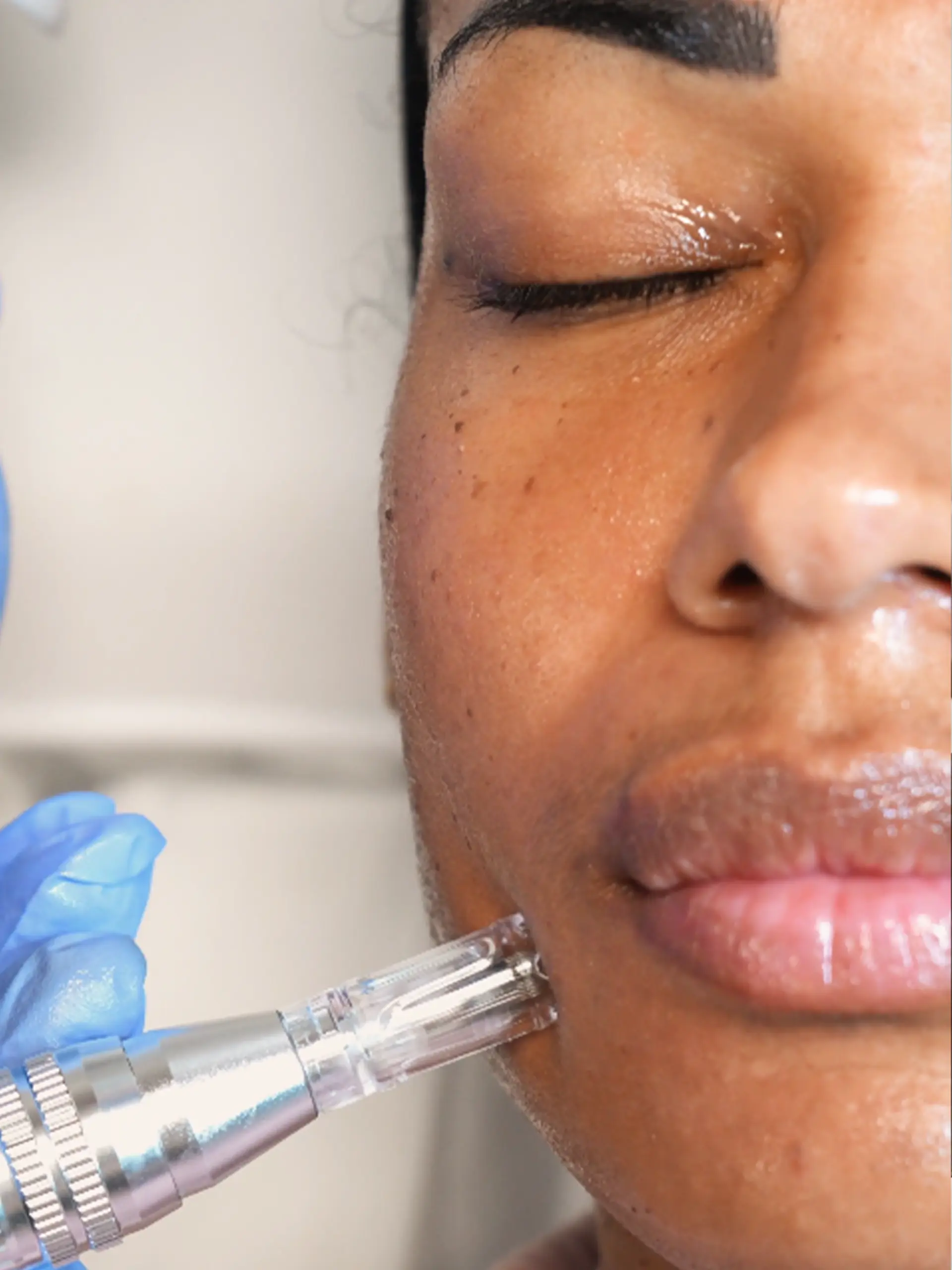 Athena Laser microneedling