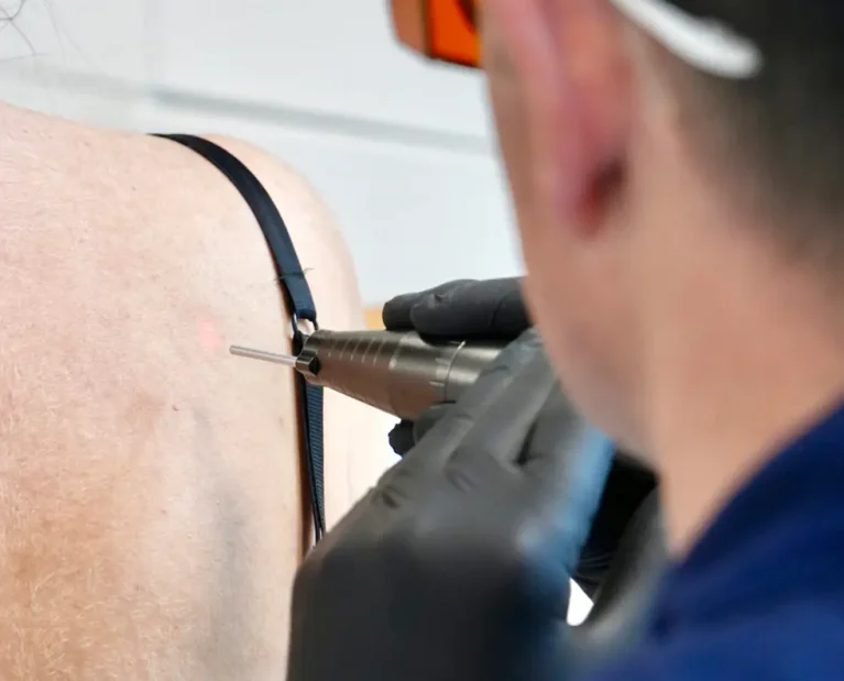 Athena Laser pilosité indésirable