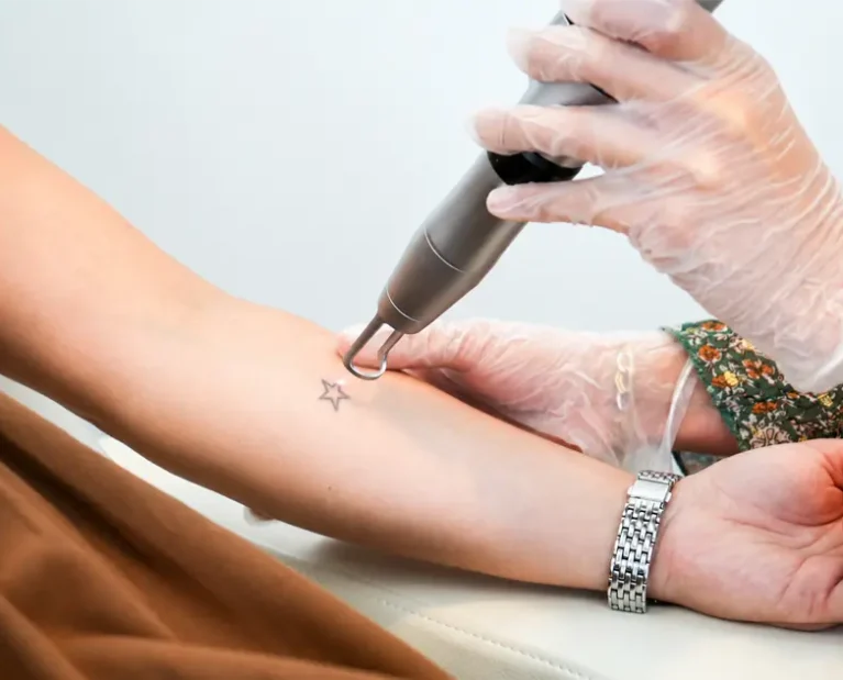 Athena Laser détatouage laser