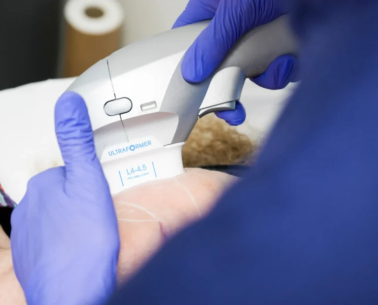 Athena laser HIFU
