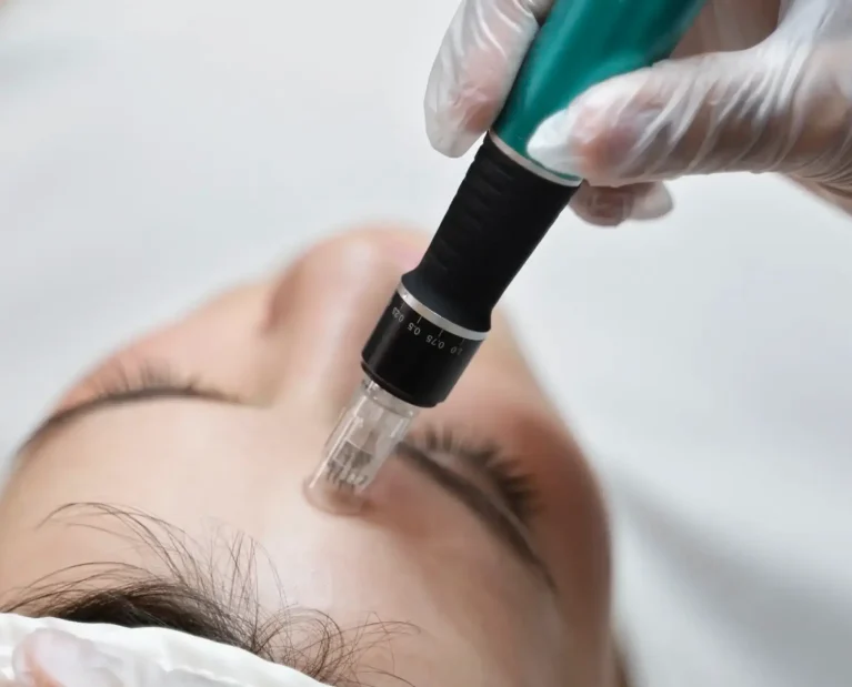 Athena Laser microneedling